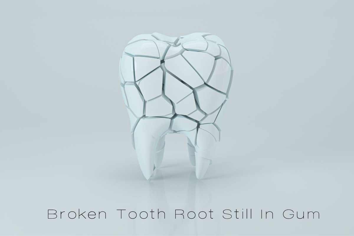 Broken Tooth Root Still In Gum L 2022