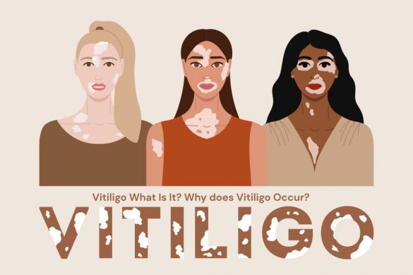 Vitiligo