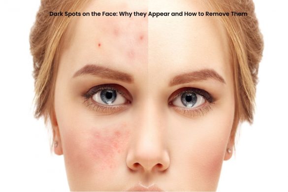 spots on the face