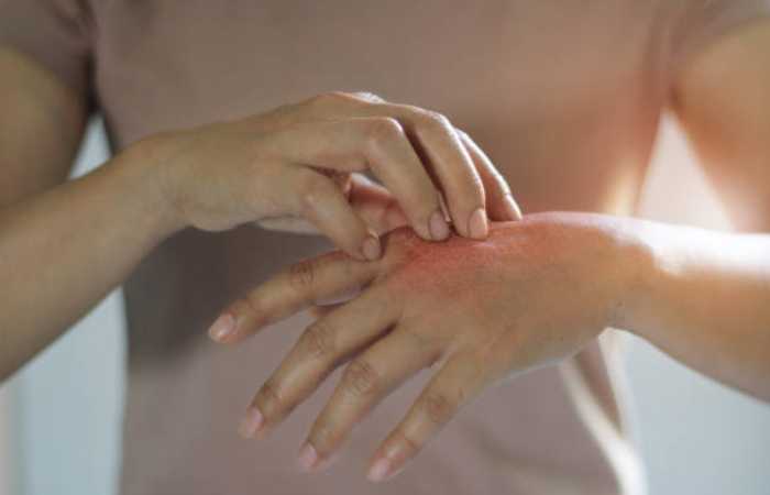 Common Skin Conditions: Various skin conditions can affect people, including: