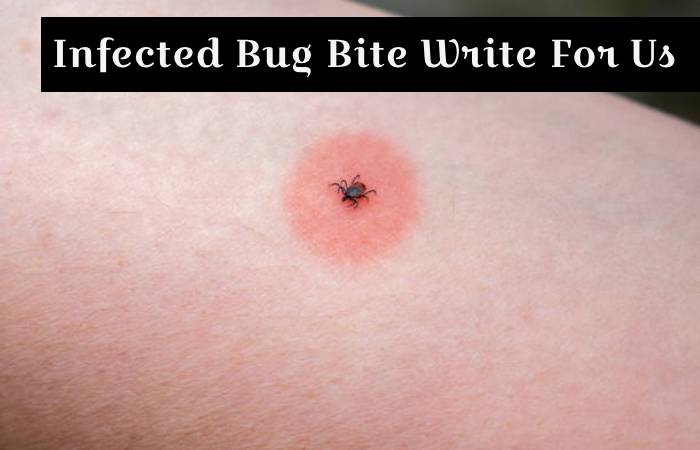 Infected Bug Bite Write For Us