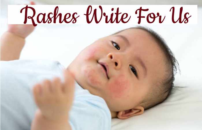 Rashes Write For Us