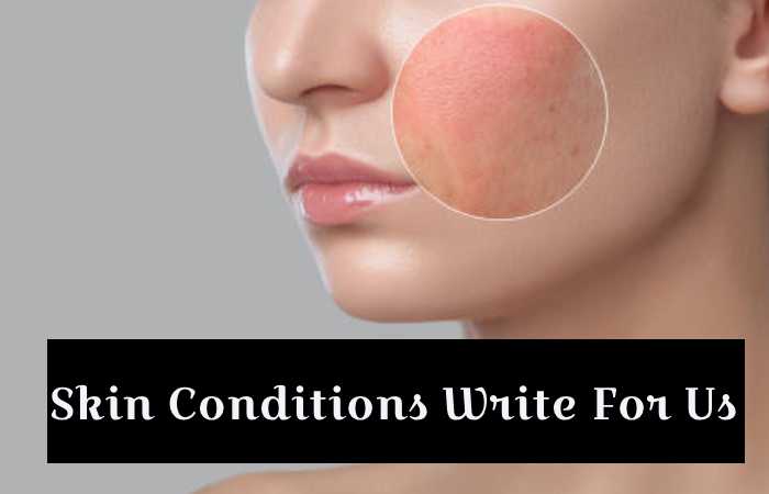 Skin Conditions Write For Us