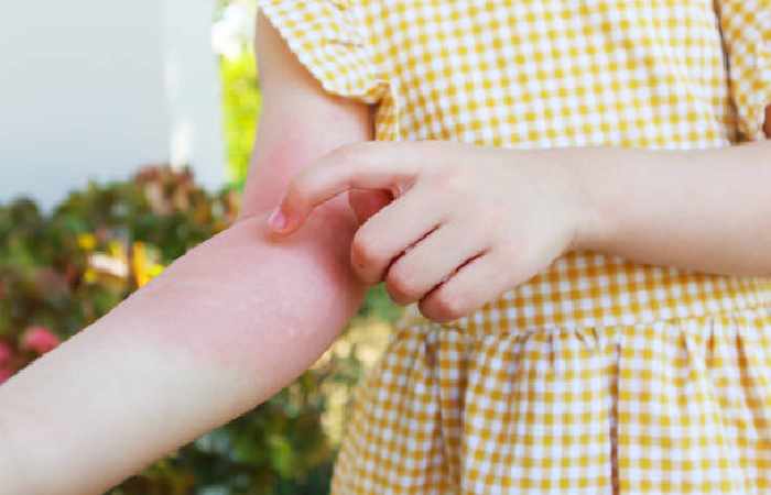 Symptoms of Rashes: