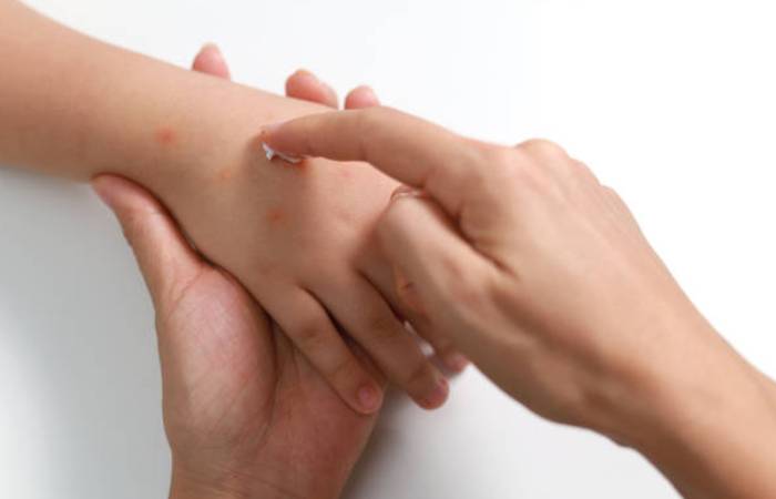 Treatment of Bug Bite