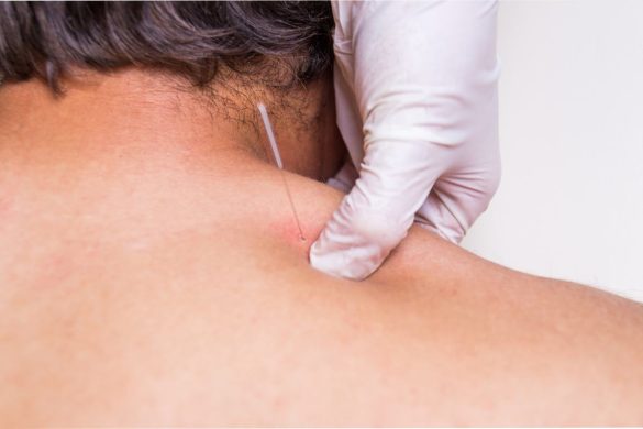 Why Opt for Dry Needling_ 9 Reasons for Pain Management