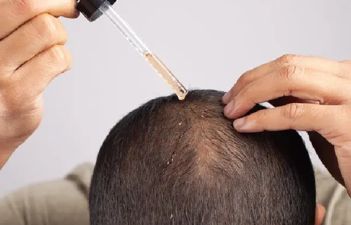 Proven Hair Loss Treatments for Men