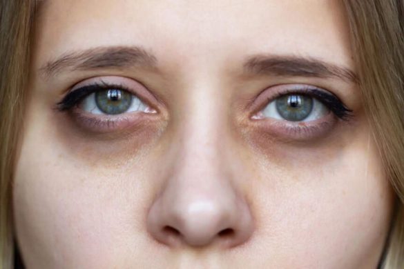 Sunken Eyes