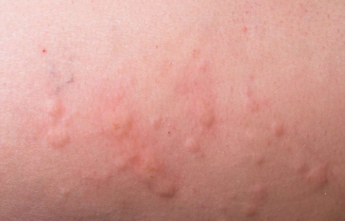 Skin Conditions Write For Us