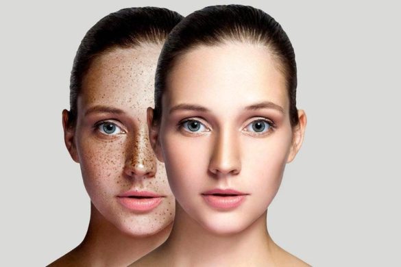 Dark Spots on the Face