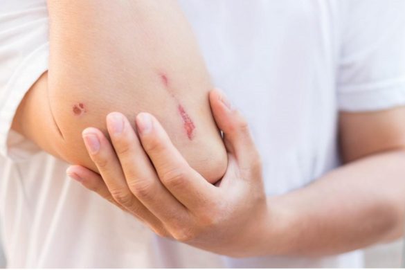 Infected Skin Wounds