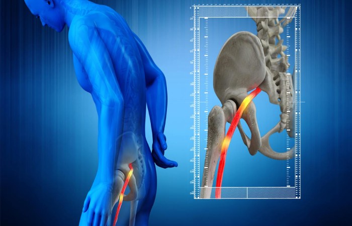 What is sciatica